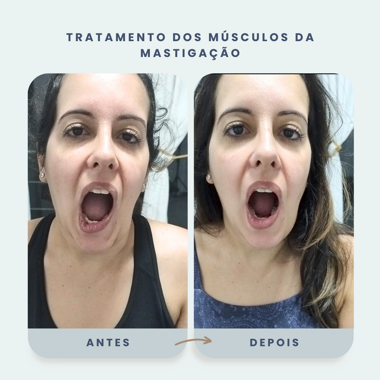 tratamento dos músculos da mastigação